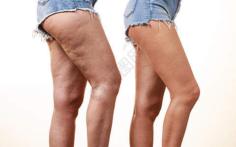 女腿部大腿与非纤维素的比较皮肤问题,身体护理,超重节食的腿与含纤维素的比较图片