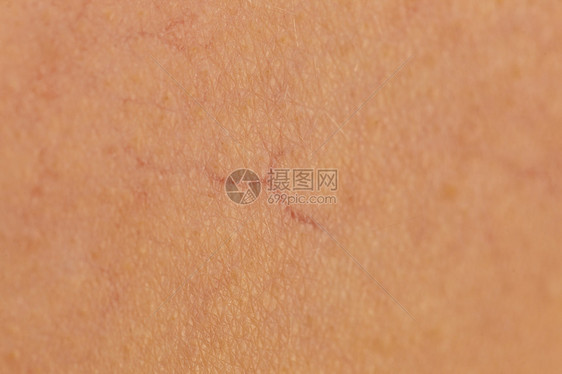 皮肤上皮肤病的人护肤问题的扩张的毛细血管,蜘蛛静脉,红色凸滑雪与扩张的毛细血管红色斑点图片