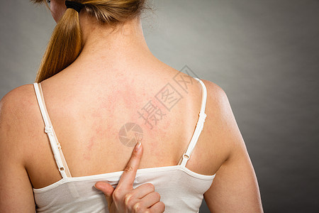 健康问题,皮肤病轻女子表现出背部瘙痒过敏皮疹荨麻疹症状女人用过敏皮疹抓痒背部背景图片