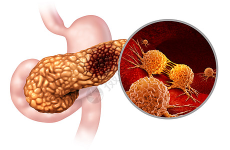 胰腺癌解剖胰腺恶肿瘤符号消化腺体的部分,用三维插图元素恶肿瘤细胞进行显微放大背景图片