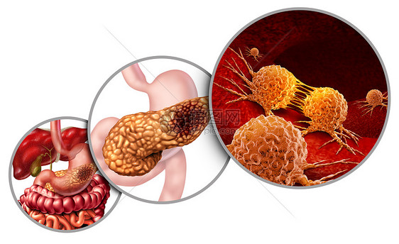 胰腺癌解剖图胰腺恶肿瘤的,消化腺体部分的医学符号,显微放大突变细胞分裂扩散的三维插图元素图片