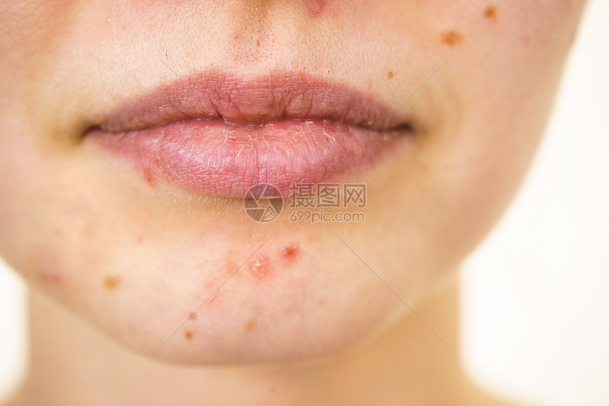 轻的女人露出脸上的痤疮痣,干燥的嘴唇十几岁的女孩下巴上没红色的斑点健康问题,皮肤病女部痤疮皮肤问题图片
