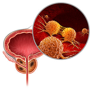 前列腺癌的医学男体内的癌细胞攻击生殖系统,人类恶肿瘤生长的象征,诊断治疗风险与三维插图元素图片