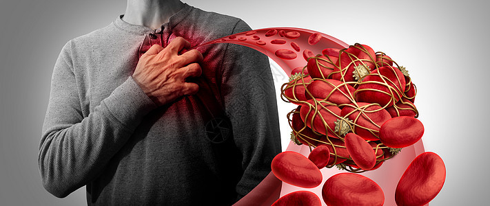 血块健康风险血栓医学插图符号人类血细胞聚集,由粘血小板纤维蛋白动脉静脉阻塞,导致心脏与三维插图元素背景图片