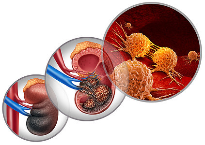 肾癌疾病医学人体恶细胞攻击泌尿系统肾癌解剖肿瘤生长治疗风险的标志与三维插图元素背景图片