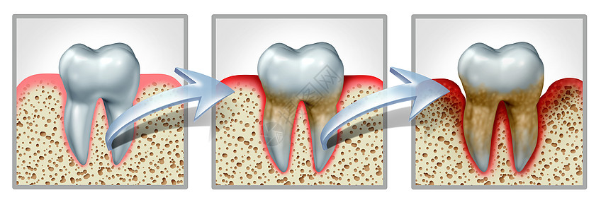 牙齿牙龈疾病医学牙科图表的,健康的牙齿,牙龈炎牙周炎,导致炎症骨丢失,因为良的口腔卫生个三维说明图片