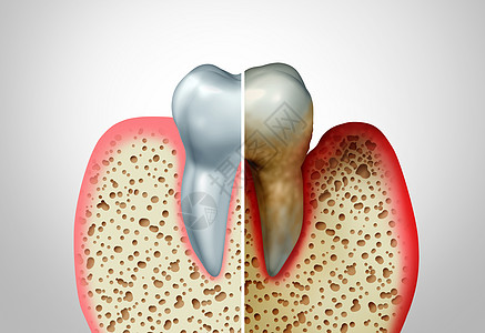 牙龈疾病与健康牙齿健康牙齿的比较,牙周炎良的口腔卫生健康问题细菌感染图的,以炎症为三维图图片