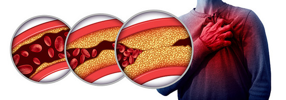 心脏病疼痛种解剖医学疾病的,与个人患心脏病个痛苦的冠状动脉事件,由于堵塞的动脉动脉斑块与三维插图元素图片