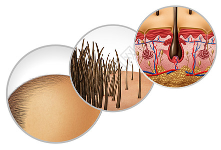 脱发图秃头秃头脱发种后退的发际线化妆品毛囊变薄脱发皮肤解剖与三维插图元素的特写图片