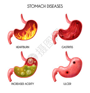 现实的人体内器官胃图标热症,火病,胃酸反流,腹部胀球,恶心矢量插图现实的人体内器官胃图标图片
