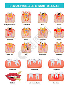 口腔问题教育信息摄影集龋炎牙菌斑,口臭,搪瓷侵蚀矢量插图图片