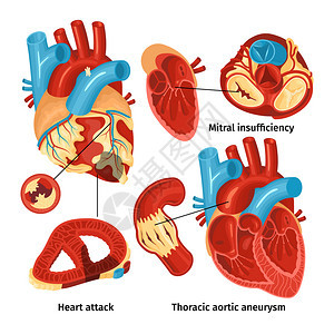 平图标与心脏解剖同类型的疾病隔离白色背景矢量插图图片