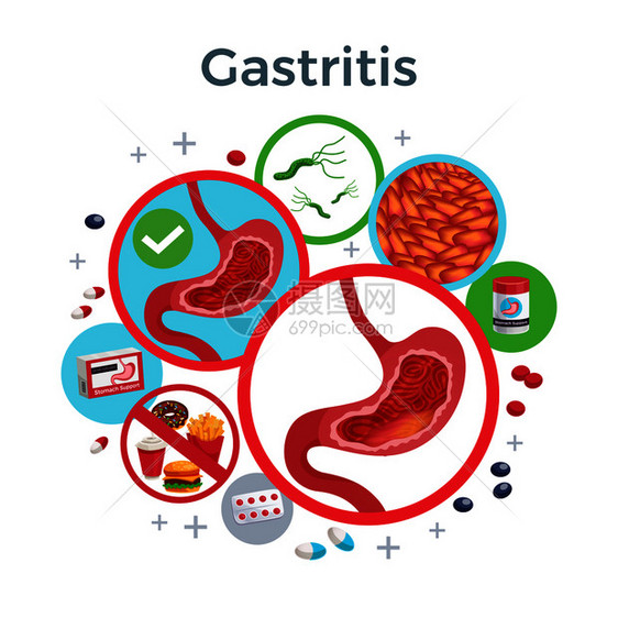 胃炎疾病症状导致药物扁平圆形成健康受影响的胃细菌食物矢量插图图片