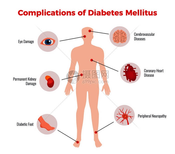 糖尿病并发症医学教育图表海报与受影响的人体器官损害描述描述平矢量插图图片