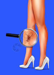 女苗条的腿静脉曲张与健康符号矢量现实插图女腿静脉曲张的现实插图图片