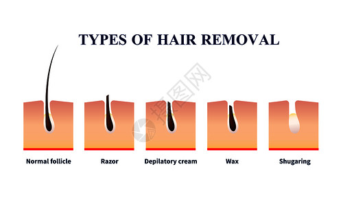 正常卵泡类型的脱毛帮助剃须刀,脱毛膏,蜡,含糖矢量插图脱毛插图的类型图片