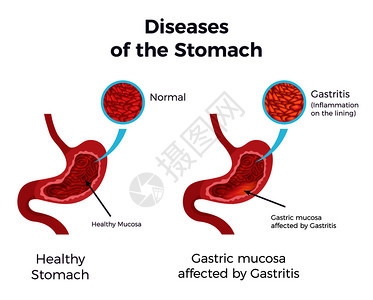 胃炎胃套图片