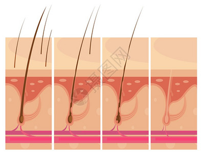 脱发皮肤的脱发故事板作文与轮廓观视图秃头头皮皮肤信息图像矢量插图图片