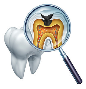 由于细菌和口腔保健中的酸细菌腐烂的放大镜和牙解剖的交叉部分以及口腔保健中的酸腐烂和缺乏刷牙导致的疾病显示放大镜和牙解剖的腐烂图片