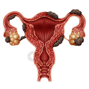 卵巢按摩内分泌硬化疾病解剖概念作为女不孕症作为子宫卵巢和输管带有组织生长的3个插图元素背景