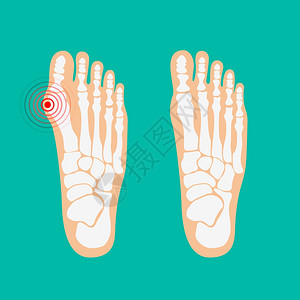 大脚趾畸形足保健矢量插图图片