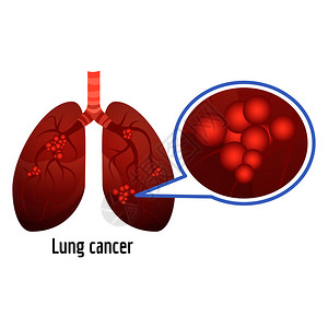 肺癌图示卡通风格背景图片