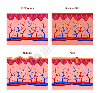 皮肤类型和健康晒伤和老皮肤痤疮向量集人体皮肤层插图皮肤类型健康晒伤和老痤疮向量集图片