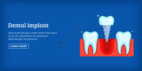 牙科植横向概念科植横向图画网上向矢量牙科植横卡通风格图片