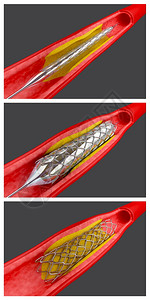 安装支架的气球血管成形程序图片