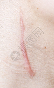 伤口消毒人类皮肤上的伤疤背景