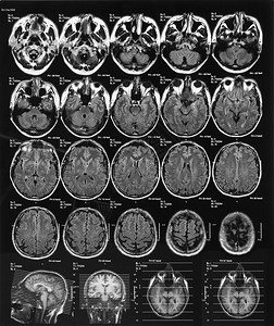 大脑X射线胶片图片