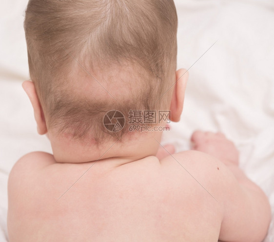 婴儿斑秃特写图片