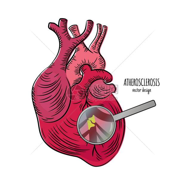 静脉硬化医学教育图心脏图片