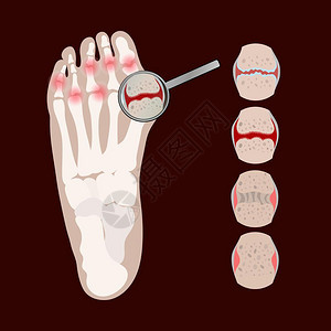 风湿类疾病插图图片
