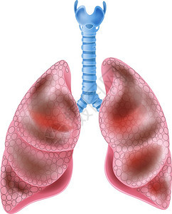 肺部吸烟者示例图片