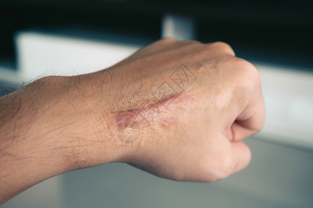 手头上有人类皮肤的疤痕图片