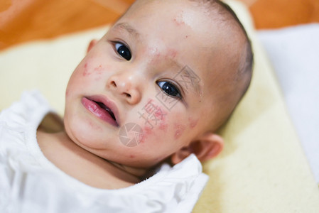 Rash婴儿面部过敏有病的面部过敏脸图片