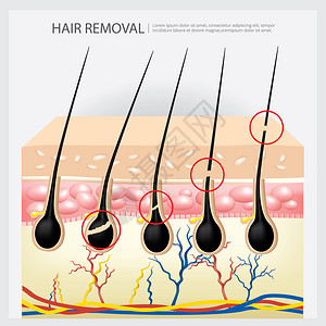 理发摘除示例矢量说明图片