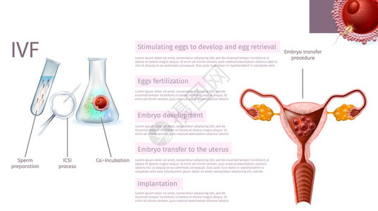 在体外受精阶段Sperm准备刺激鸡蛋ICSI进程Emplyo开发联合孵化转移到Uterus植入现实矢量医学封条复制空间图片