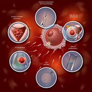 活化肥体成像学通过人工合并拉比迪什的鸡蛋和Sperm进行肥化过程然后将Embryo转基因至Uterus矢量现实说明IVF医疗银行图片