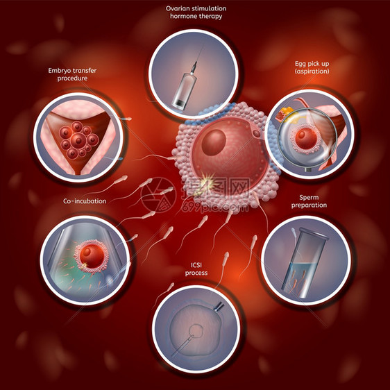 活化肥体成像学通过人工合并拉比迪什的鸡蛋和Sperm进行肥化过程然后将Embryo转基因至Uterus矢量现实说明IVF医疗银行图片