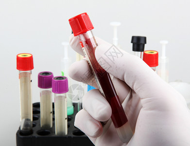 保加利亚Burgas2013年月日科学家在他的实验室工作血液测试定期验血是跟踪你总体身健康状况的最重要方法之一图片