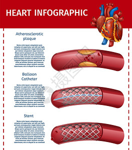 现实矢量说明心脏和神乐控制船现代外科治疗班员方法关于Stent气球导管室技术的信息心脏病诊所着陆页现实心脏内外科手术班员图片