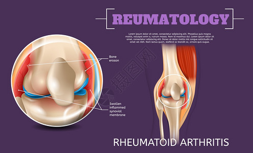 3d矢量图像再生机解剖人体膝关节炎医学可视长期耐久膝伤害外观研究结构科问题合腿图片