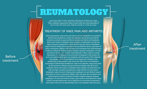 膝部疼痛和关节炎治疗说明图片