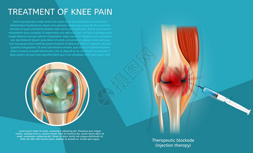 3d矢量图像Banner治疗裂缝人体膝关节Syringe注射医疗海报程序和注射治疗结果图片