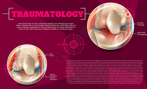 3dVectorBanner图像人体解剖膝关节影响和治疗伤害图片