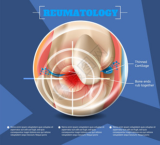 3d矢量图像导体解剖医学结构类型伤害和人体膝盖疾病联合骨结瘦化工厂图片