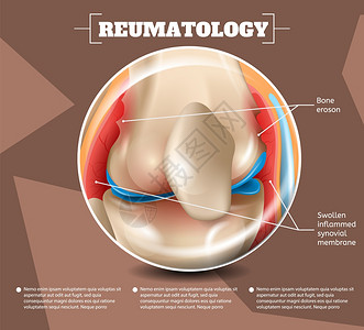 3d矢量图像导体解剖医学结构类型伤害和疾病BoneEroson肿胀的InflammedSynovialMembrane人类膝关节图片