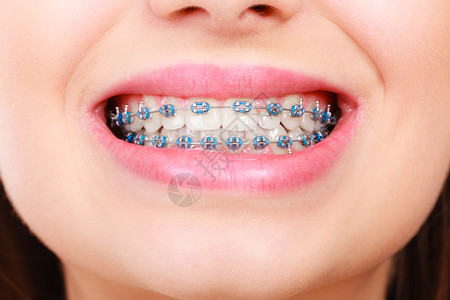 妇女微笑用蓝色牙套露出白图片